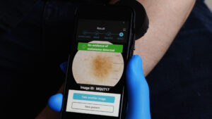 App visar att inga tecken på cancer finns i hudförändringen.